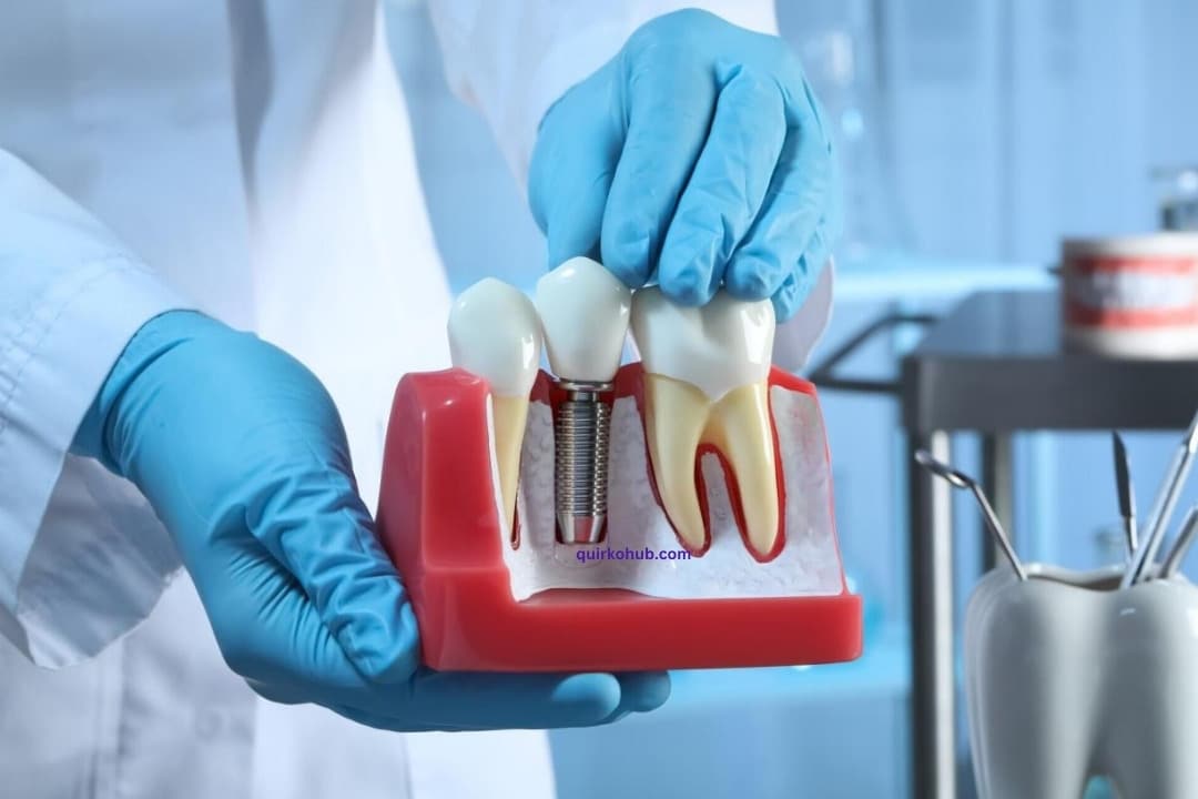 Tooth Imploding The Ultimate Guide to Tooth Implant: Everything You Need to Know ...